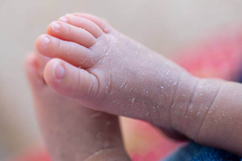 What To Do If Your Baby Has Dry Skin 